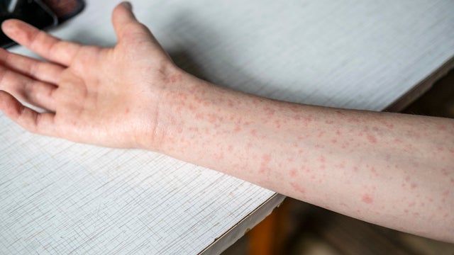 A teenager's hands covered in a measles rash. 